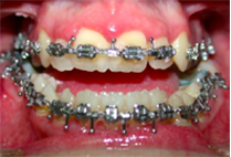 implantes dentales